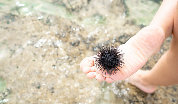 Aua, der Seeigel steckt mit seinen Stacheln im Fu&szlig;