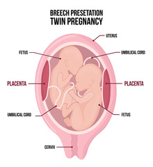 Obraz premium Anatomy of abdomen with twins. Pregnancy women diagrams with breech presentation for both children.