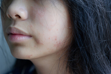 rash face woman allergic to cosmetics food allergy or air allergy