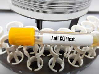 Blood sample for Anti-CCP test, diagnosis for rheumatoid arthritis disease. Cyclic citrullinated...