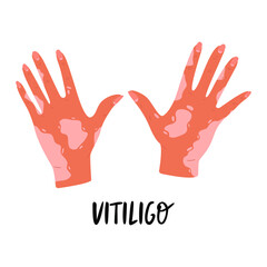 Flat vector cartoon illustration of hands with vitiligo. World vitiligo day. Skin diseases, pigmentation disorders. Isolated design on a white background.