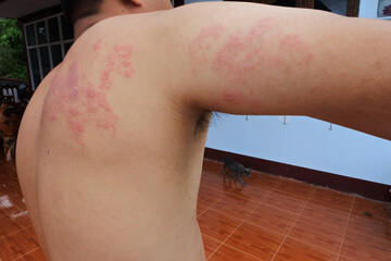 Skin diseases caused by viral infections,shingles