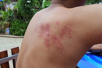 Skin diseases caused by viral infections,shingles