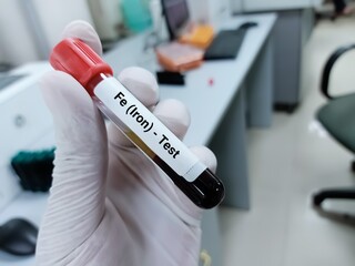 Biochemist of doctor holds blood sample for Transferrin test. Iron deficiency anemia, TIBC. Medical...