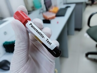 Biochemist or doctor holds blood sample for pancreatitis test, amylase, lipase. Medical test tube in laboratory background.