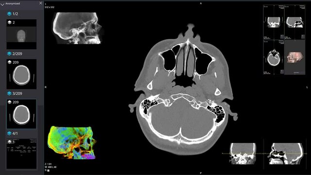 Computed tomography of the head.