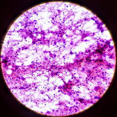 Microscopic view of Metastatic squamous cell carcinoma, atypical squamous epithelial cells,...