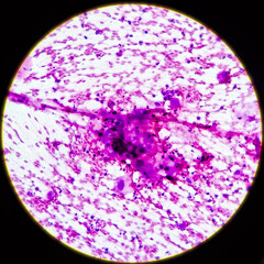 Microscopic view of Metastatic squamous cell carcinoma, atypical squamous epithelial cells, Atypical keratinized cells are noted, sample aspirate from inguinal lymph node by FNAC, 40x view