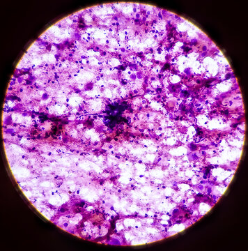 Microscopic view of Metastatic squamous cell carcinoma, atypical squamous epithelial cells, Atypical keratinized cells are noted, sample aspirate from inguinal lymph node by FNAC, 40x view