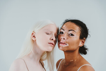 Group of multiethnic women with different kind of skin posing together in studio. Concept about body positivity and self acceptance - obrazy, fototapety, plakaty