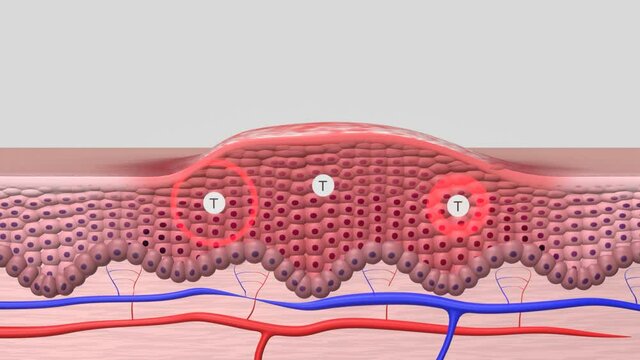 Animation der Schuppenflechte/Psoriasis