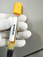 Fototapeta na wymiar Blood sample tube with sample for Anti sperm antibody test
