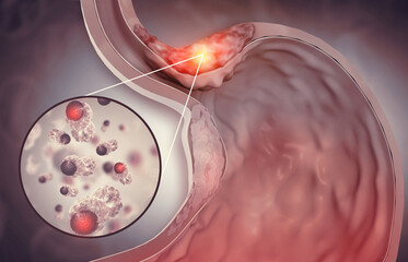 Stomach cancer. Cancer attacking cell. Stomach disease concept. 3d illustration