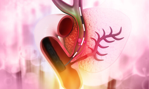 Endoscopic removal of gallstones from the gallbladder ducts. Pancreas. 3d illustration