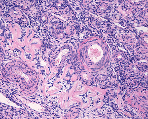 Follicular atresia