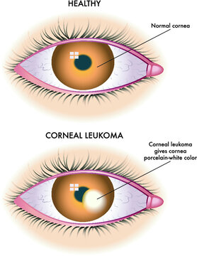 Medical illustration shows the comparison between a normal eye and one affected by corneal leucoma.