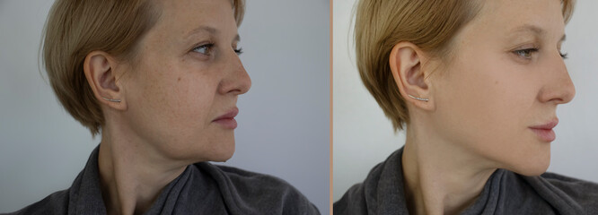 woman face wrinkles before and after treatment