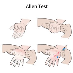 알렌테스트 수족냉증 검사