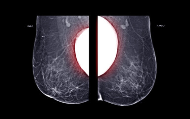  X-ray Digital Mammogram  or mammography  both side of the breast  MLO view  with Breast Implants...