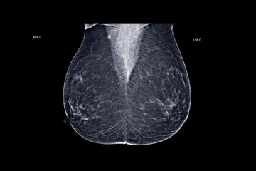  X-ray Digital Mammogram  or mammography  both side of the breast  MLO view  for diagnonsis Breast cancer in women isolated on black background. - obrazy, fototapety, plakaty