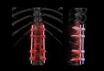 lumbar spine AP and Lateral view  for diagnosis spinal canal stenosis and degenerative disc disease showing pedicle screw implant after surgical decompression and spinal fusion. - obrazy, fototapety, plakaty