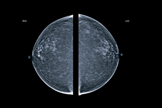 X-ray Digital Mammogram  or mammography  both side of the breast  CC view  for diagnonsis Breast cancer in women isolated on black background.