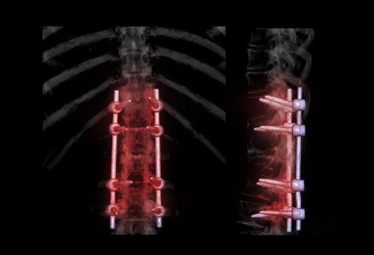 lumbar spine AP and Lateral view  for diagnosis spinal canal stenosis and degenerative disc disease showing pedicle screw implant after surgical decompression and spinal fusion.