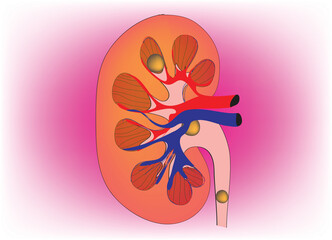 Biological illustration of kidney stones 