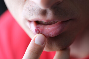 Herpes on male inner lip closeup. Symptoms and treatment of herpes