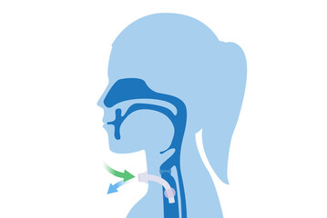 Surgical to inserted a siliconized tube into the Woman's neck and trachea to help breathe. Illustration about Medical to help a patient who can not breathe with nose and mouth.
