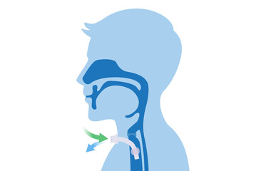 Surgical to inserted a siliconized tube into the men's neck and trachea to help breath. Illustration about Medical to help a patient who can not breathe with nose and mouth.