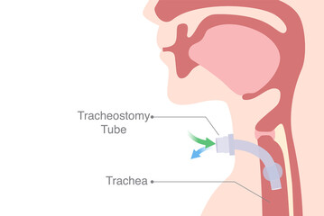 Tracheostomy is an opening created at the front of the neck for inserted a siliconized tube into the trachea to help breathe.