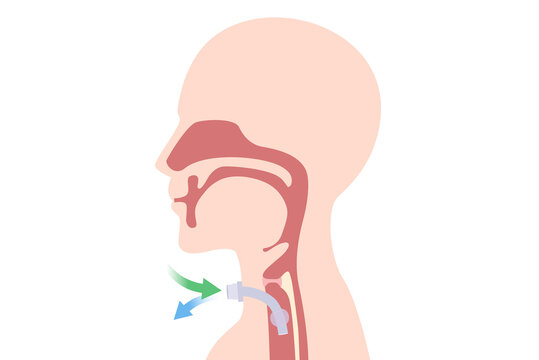 Tracheostomy at the human neck for inserted a siliconized tube into the trachea to help breathe. Illustration about surgical to help a patient who can not breathe with nose and mouth with a tube.