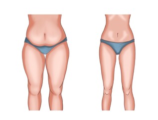 illustration of the body before and after weight loss or liposuction