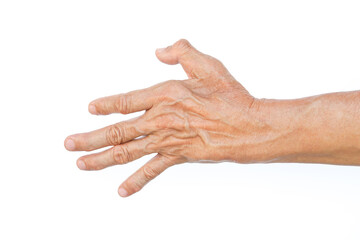 an old man left hand muscle atrophy between a thumb and index finger 