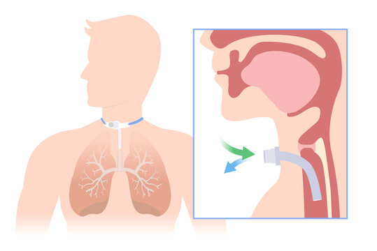 Insert the siliconized tube into the trachea to help breathe into the lunge. Illustration about Anatomy of Tracheostomy is surgical at the neck and windpipe to help a patient.