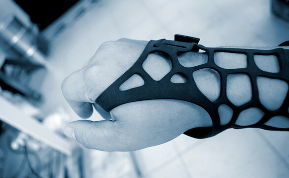 Black Orthopedic Plastic Prosthesis Printed On 3D Printer On Hand.