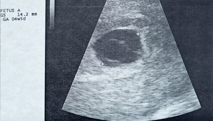 Ultrasound image of the gestational sac and the vitelline bladder with the embryo, of a pregnancy...