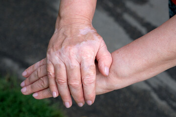 Female hands with vitiligo close-up. Woman's hands folded one on top of the other, nails without...