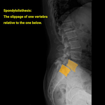x ray image of  spondylolisthesis vertebral x ray