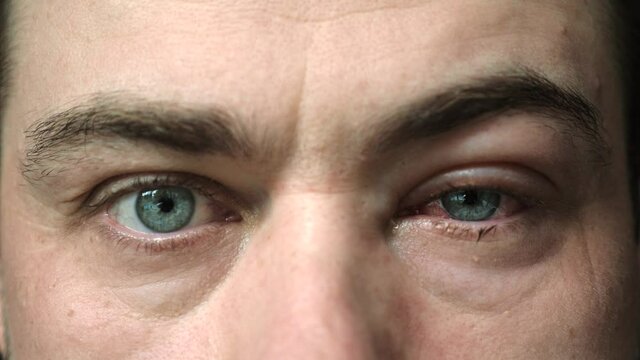 Close Up of Severe Bloodshot Red Blood Eye of Male Affected by Conjunctivitis or After Allergy. Man Looking at Camera with Viral Blepharitis, Conjunctivitis. Irritated, Infected Eye or Insect Bite