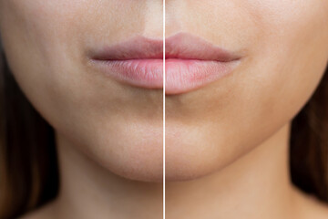 Cropped shot of young women's face with lips before and after lip enhancement. Injection of filler in lips. Close-up