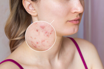 Cropped shot of a young woman's face with acne skin in zoom circle. Pimples, red scars, rash on...