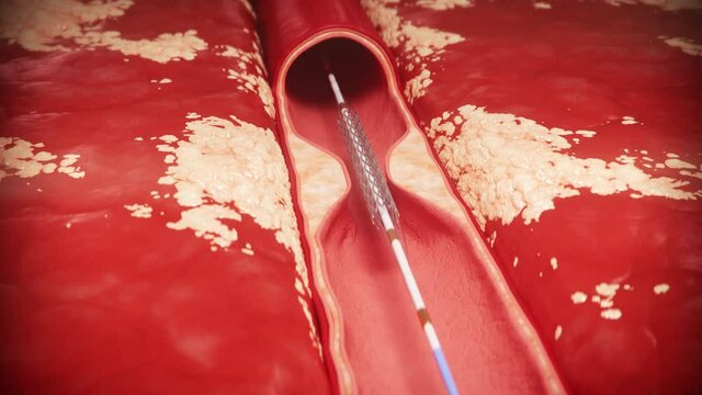 3D Medical Illustration Of Balloon Stent Angioplasty Procedure