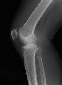 x ray of a fabella lateral knee