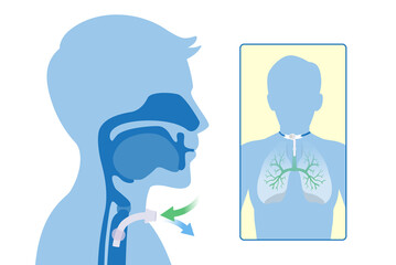 Insert the siliconized tube into the trachea to help breathe. Illustration about Anatomy of Tracheostomy is surgical at the neck and airway to help a patient.