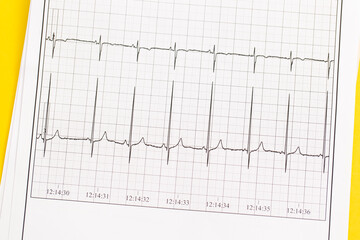 Close up of ECG, electrocardiogram. The work of a healthy heart on paper.