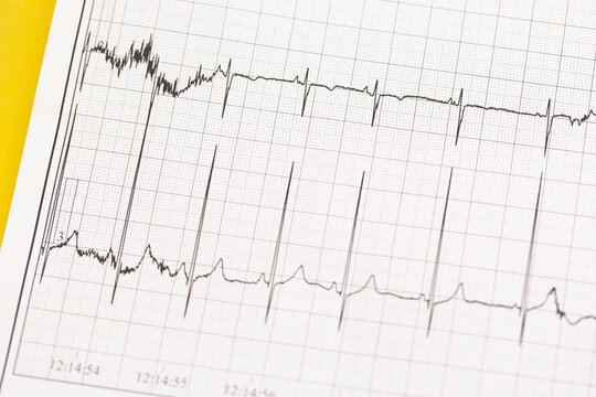 Close up of ECG, electrocardiogram. The work of a healthy heart on paper.