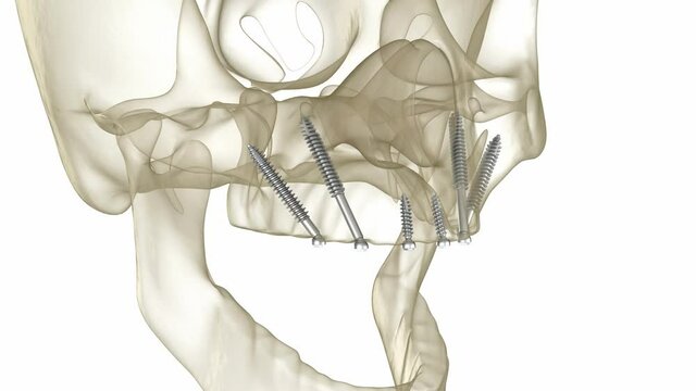 Maxillary prosthesis supported by zygomatic implants. Medically accurate 3D animation of human teeth and dentures