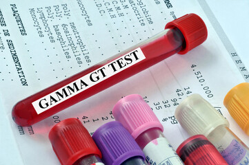 Tube de sang pour un test gamma GT posé sur des résultats d'analyse de sang
